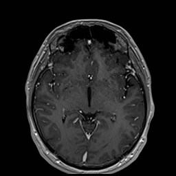 Cochlear incomplete partition type III associated with hypothalamic hamartoma (Radiopaedia 88756-105498 Axial T1 C+ 97).jpg