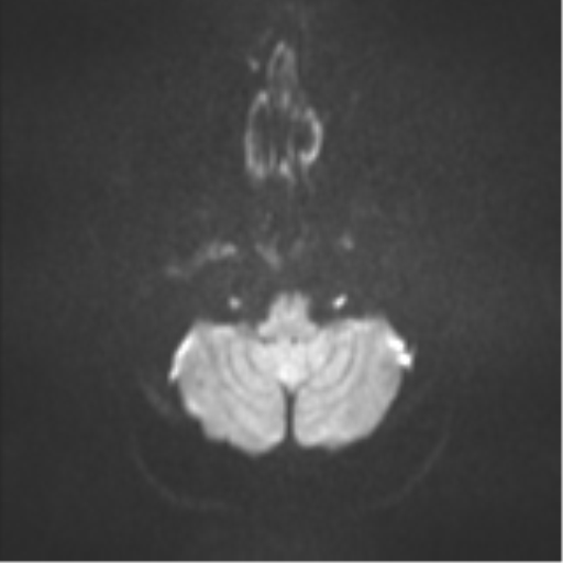 File:Colloid cyst (Radiopaedia 53164-59125 Axial DWI 32).png