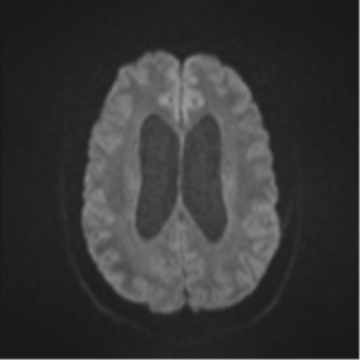 File:Colloid cyst (Radiopaedia 53164-59125 Axial DWI 46).png