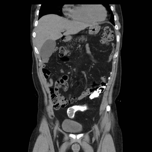 File:Colocutaneous fistula in Crohn's disease (Radiopaedia 29586-30093 E 8).jpg