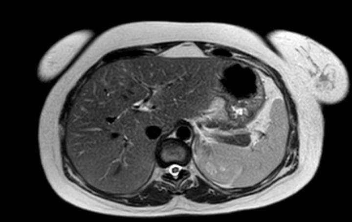 Colon adenocarcinoma with Krukenberg tumors, advanced pregnancy (Radiopaedia 67279-76645 Axial T2 67).jpg
