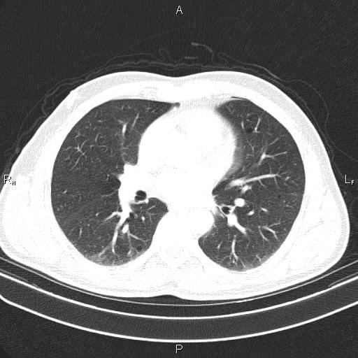 File:Colon cancer (Radiopaedia 85663-101443 Axial lung window 34).jpg