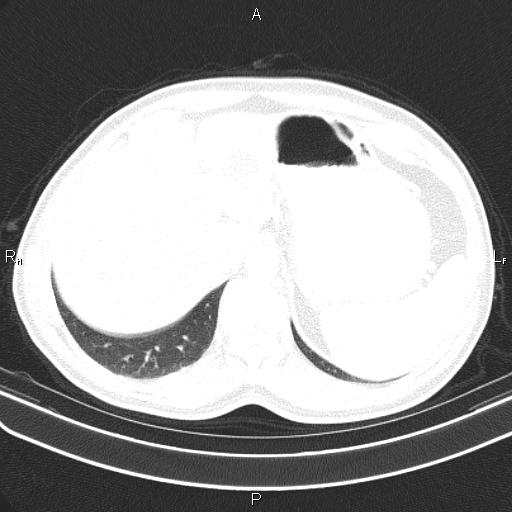File:Colon cancer (Radiopaedia 85663-101443 Axial lung window 61).jpg
