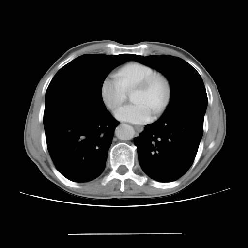 File:Colon cancer with calcified liver metastasis (Radiopaedia 74423-85307 A 1).jpg