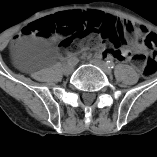 Colon cancer with calcified liver metastasis (Radiopaedia 74423-85309 Axial non-contrast 76).jpg