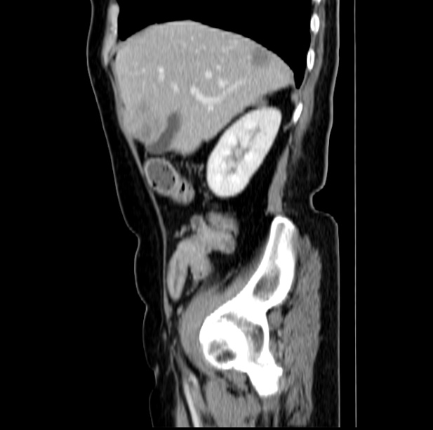Colon carcinoma with hepatic metastases (Radiopaedia 29477-29961 C 15).jpg