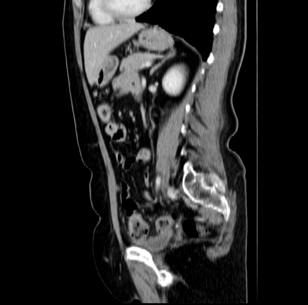 Colon carcinoma with hepatic metastases (Radiopaedia 29477-29961 C 35).jpg