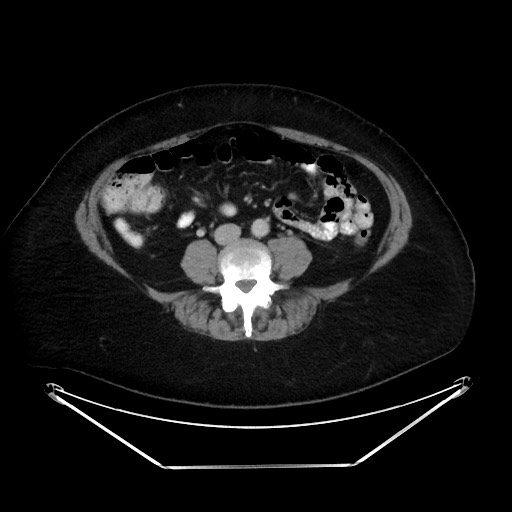 File:Colonic intussusception due to adenocarcinoma (Radiopaedia 86828-102987 A 91).jpg