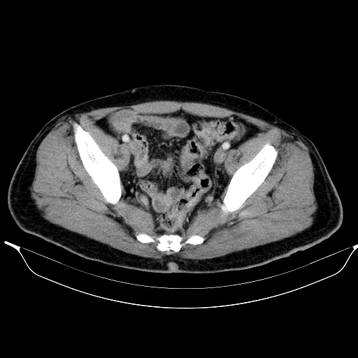 Colonic lipoma with colo-colic intussusception (Radiopaedia 58944-66200 A 57).jpg