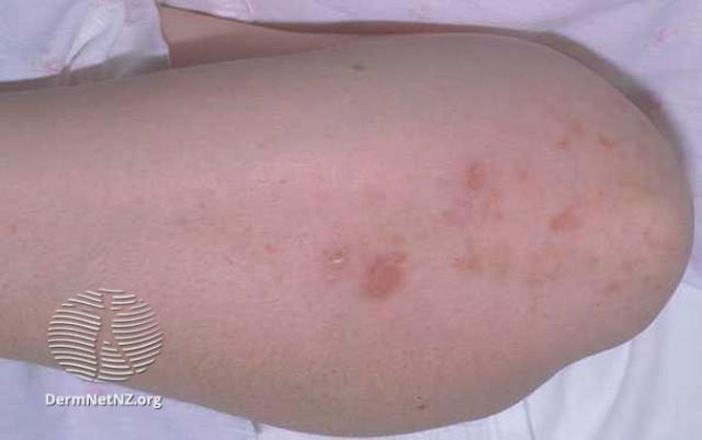 File:Dermatitis herpetiformis (DermNet NZ immune-dh2).jpg