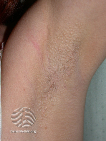 File:Fox-Fordyce disease (DermNet NZ hair-nails-sweat-fox-fordyce3).jpg