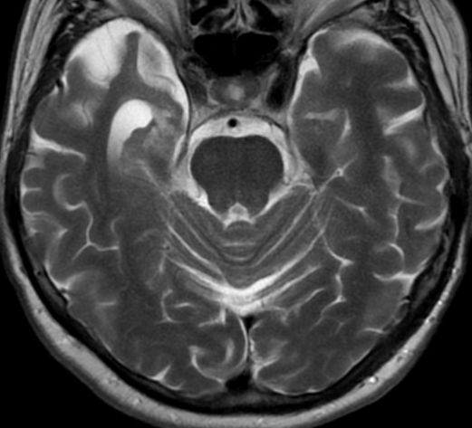 File:Mesial temporal lobe sclerosis (Radiopaedia 14244).jpg