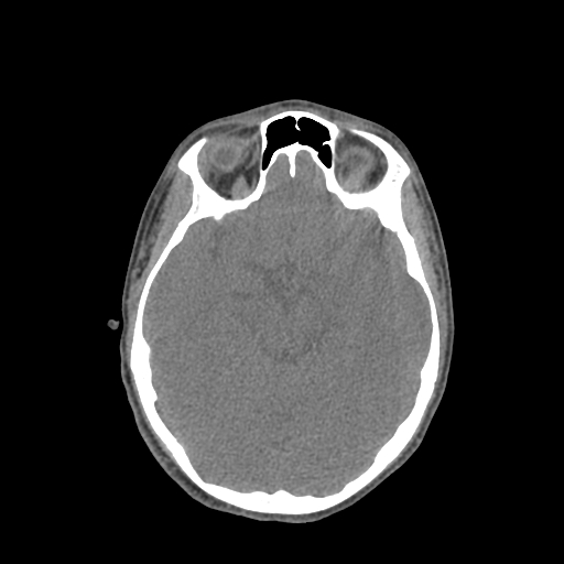 File:Nasal pyogenic granuloma (lobular capillary hemangioma) (Radiopaedia 85536-101244 Axial non-contrast 119).jpg