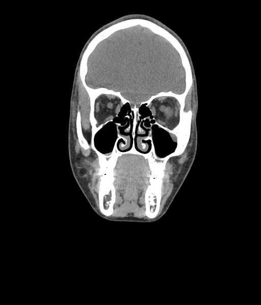 Nasal pyogenic granuloma (lobular capillary hemangioma) (Radiopaedia 85536-101244 Coronal non-contrast 81).jpg