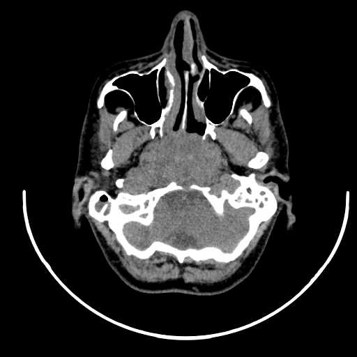 File:Nasopharyngeal carcinoma - infiltrating the clivus (Radiopaedia 62583-70875 Axial non-contrast 15).jpg