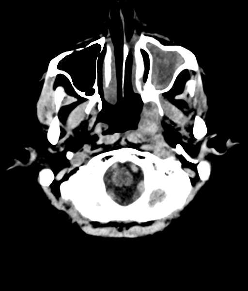 File:Nasopharyngeal carcinoma with cerebral abscess (Radiopaedia 43018-46275 Axial non-contrast 8).png