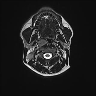 File:Nasopharyngeal carcinoma with perineural spread (Radiopaedia 55030-61380 Axial T2 41).jpg