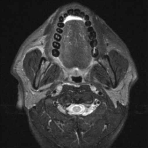 File:Nasopharyngeal carcinoma with pterygopalatine fossa involvement (Radiopaedia 33102-34134 Axial T2 10).png