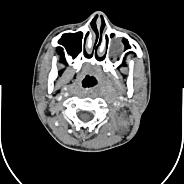 Nasopharyngeal carcinoma with skull base invasion (Radiopaedia 53415-59705 A 67).jpg