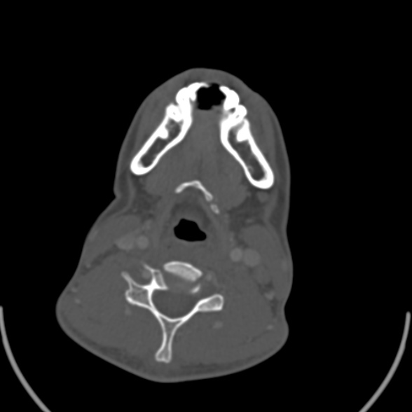 Nasopharyngeal carcinoma with skull base invasion (Radiopaedia 53415-59705 Axial bone window 134).jpg