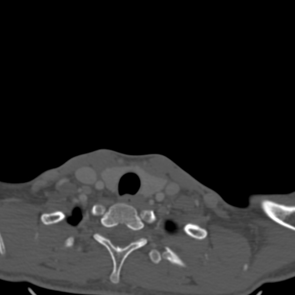 Nasopharyngeal carcinoma with skull base invasion (Radiopaedia 53415-59705 Axial bone window 188).jpg