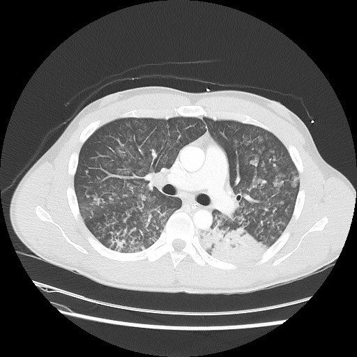 Near-drowning pulmonary edema (Radiopaedia 59457-66814 Axial lung window 25).jpg