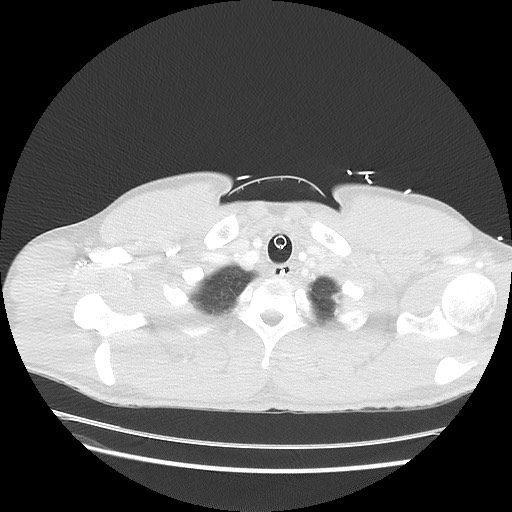 Near-drowning pulmonary edema (Radiopaedia 59457-66814 Axial lung window 3).jpg
