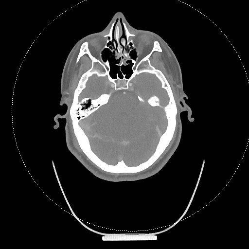 Neck CT angiogram (intraosseous vascular access) (Radiopaedia 55481-61945 B 281).jpg