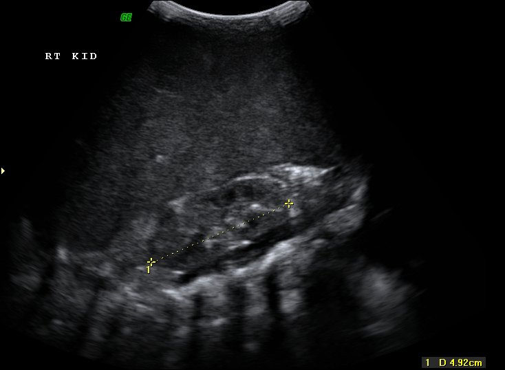 File:Neonatal neuroblastoma (Radiopaedia 9564-10221 A 6).jpg