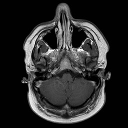 File:Neuro-Behcet's disease (Radiopaedia 21557-21505 Axial T1 C+ 4).jpg