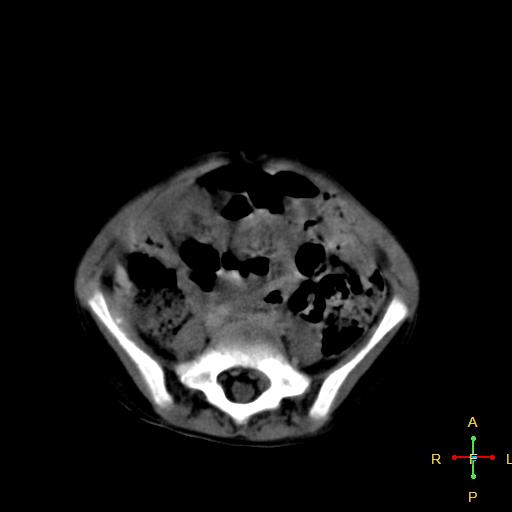 File:Neuroblastoma (Radiopaedia 24751-25016 D 29).jpg