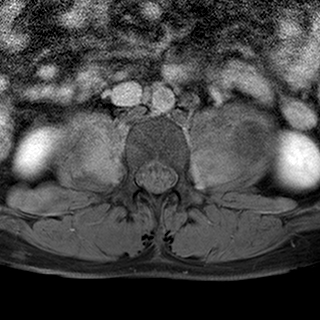 File:Neurofibromatosis type 1- extensive spinal involvement and Christmas tree sign (Radiopaedia 60610-68332 Axial T1 C+ fat sat 68).jpg