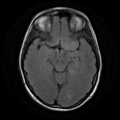 File:Neurofibromatosis type 2 (Radiopaedia 45229-49244 Axial FLAIR 8).png