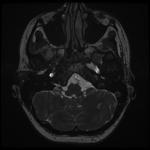 Neurofibromatosis type 2 - bilateral acoustic neuromata (Radiopaedia 40060-42566 Axial FIESTA 20).png