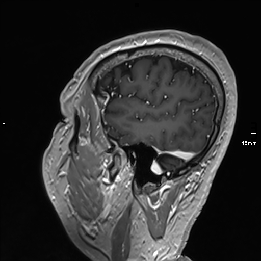 Neurosarcoidosis - involvement of the mesial temporal lobes (Radiopaedia 67429-76820 Sagittal T1 C+ 138).jpg