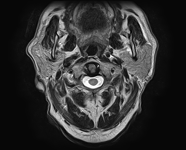 File:Non-Hodgkin lymphoma - parotid gland (Radiopaedia 71531-81890 Axial T2 15).jpg
