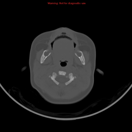 File:Non-accidental injury - bilateral subdural with acute blood (Radiopaedia 10236-10765 Axial bone window 1).jpg