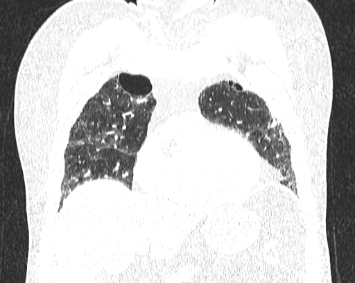 Non-specific interstitial pneumonia (NSIP) (Radiopaedia 68599-78228 Coronal lung window 24).jpg