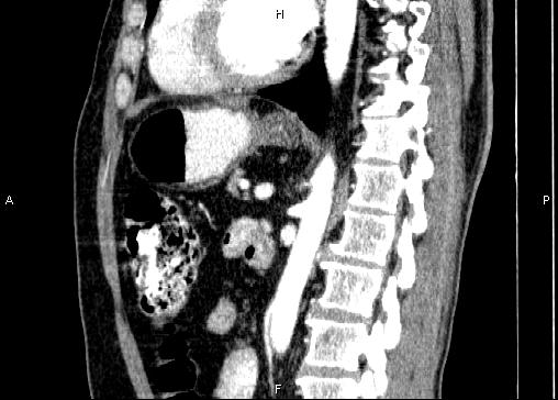 Non-syndromic pancreatic endocrine tumor (Radiopaedia 86958-103178 E 60).jpg
