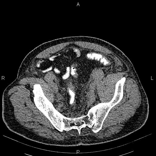 File:Non Hodgkin lymphoma in a patient with ankylosing spondylitis (Radiopaedia 84323-99621 Axial non-contrast 53).jpg