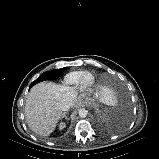 File:Non Hodgkin lymphoma in a patient with ankylosing spondylitis (Radiopaedia 84323-99621 B 28).jpg