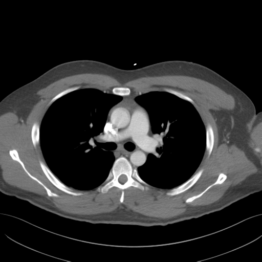 File:Normal CTA thorax (non ECG gated) (Radiopaedia 41750-44704 A 40).png