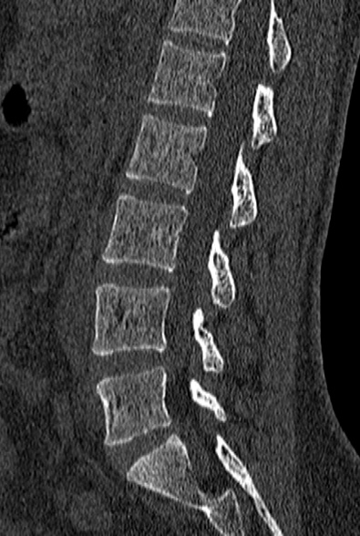 File:Normal CT lumbar spine (Radiopaedia 53981-60118 Sagittal bone window 55).jpg