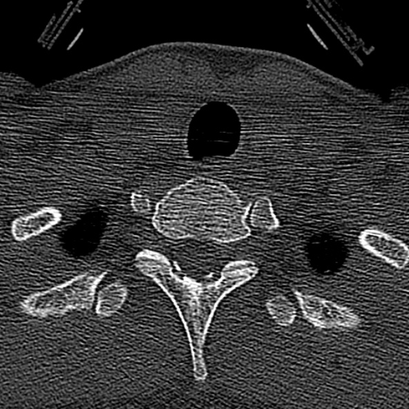 Normal CT of the cervical spine (Radiopaedia 53322-59305 Axial bone window 241).jpg