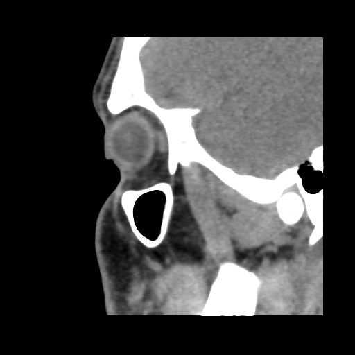 Normal CT paranasal sinuses (Radiopaedia 42286-45390 F 116).jpg