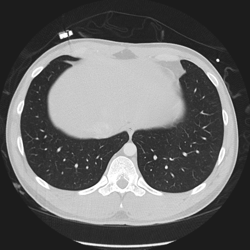 Normal CT pulmonary veins (pre RF ablation) (Radiopaedia 41748-44702 Axial lung window 55).png