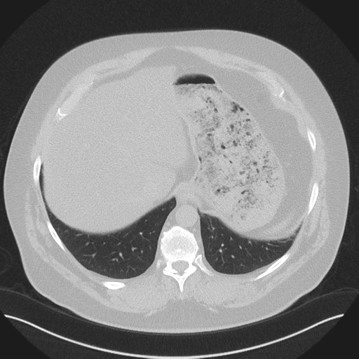 Normal HRCT (Radiopaedia 40797-43458 Axial lung window 50).png