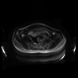 Normal MRI abdomen in pregnancy (Radiopaedia 88001-104541 Axial DWI 95).jpg