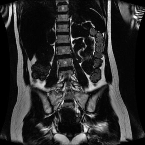 Normal MRI abdomen in pregnancy (Radiopaedia 88001-104541 N 92).jpg