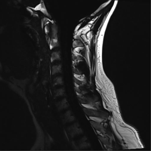 File:Normal MRI cervical spine (infection protocol) (Radiopaedia 53916-60039 F 9).png